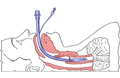 Side view diagram of a person with a correctly placed endotracheal tube, for medbridge training.