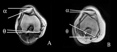MRI images A and B show joint cross-sections with marked angles α and θ, aiding medbridge education.
