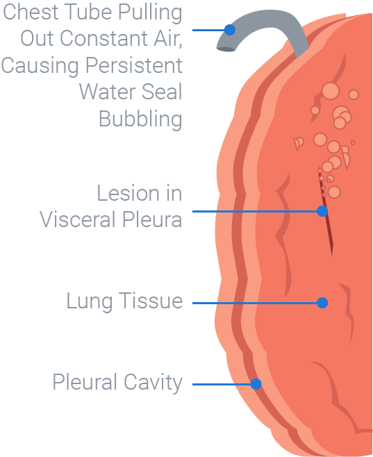 Diagram of a chest tube with continuous air extraction and bubbling, highlighting the pleural cavity, lung tissue, and visceral pleura lesion for medbridge training.