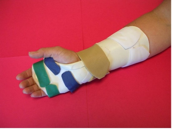 An arm in a colorful orthopedic cast on a red surface represents Medbridge's advancements in patient care software.