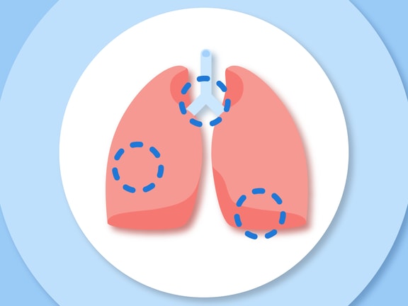 Medbridge illustration of lungs with highlighted areas on a blue concentric circle background.