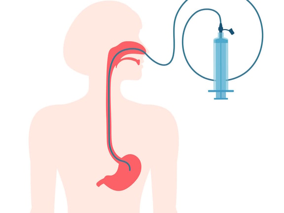 Nasogastric tube inserted through nose into stomach, attached to syringe for medical use, as shown in medbridge materials.