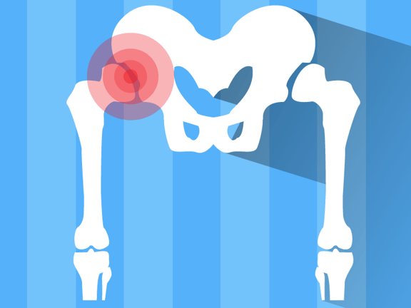 Silhouette of a pelvic bone on blue stripes with a red circle highlighting the hip joint for medbridge.