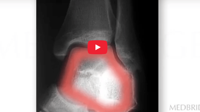 X-ray of an ankle with a red highlight on the heel, for medbridge healthcare education.