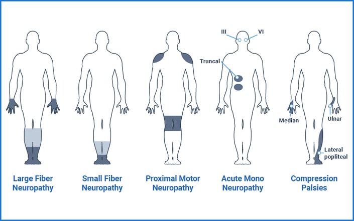 Diagram of neuropathy types highlighting affected areas, created using Medbridge software.