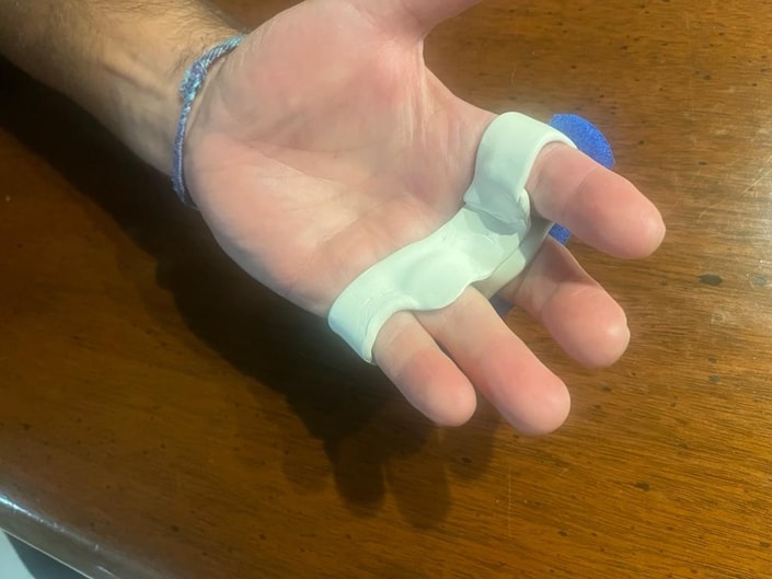 Hand with a custom-molded relative motion orthosis supporting the fingers in controlled extension after extensor tendon repair.