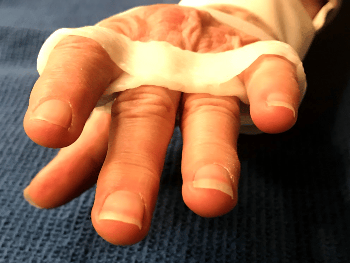 Close-up of fingers positioned in a relative motion orthosis, designed to protect the repaired extensor tendon while allowing movement.
